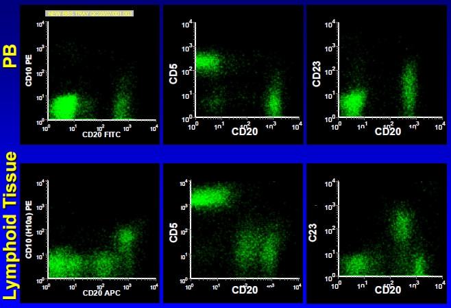 澳科学家确认基因Mcl-1或因风湿性关节失调