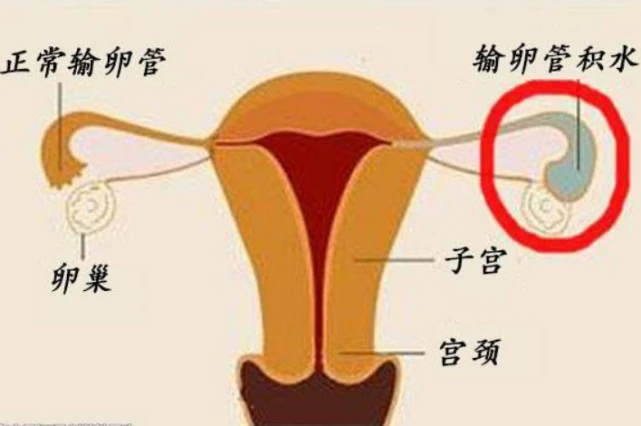 九零后做人流八零后治不孕的原因有哪些?(图2) 不孕不孕哪家医院好_不不育不孕_不孕不育