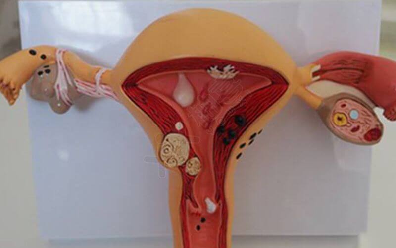 治疗排卵障碍有多种方法,常见的是药物治疗