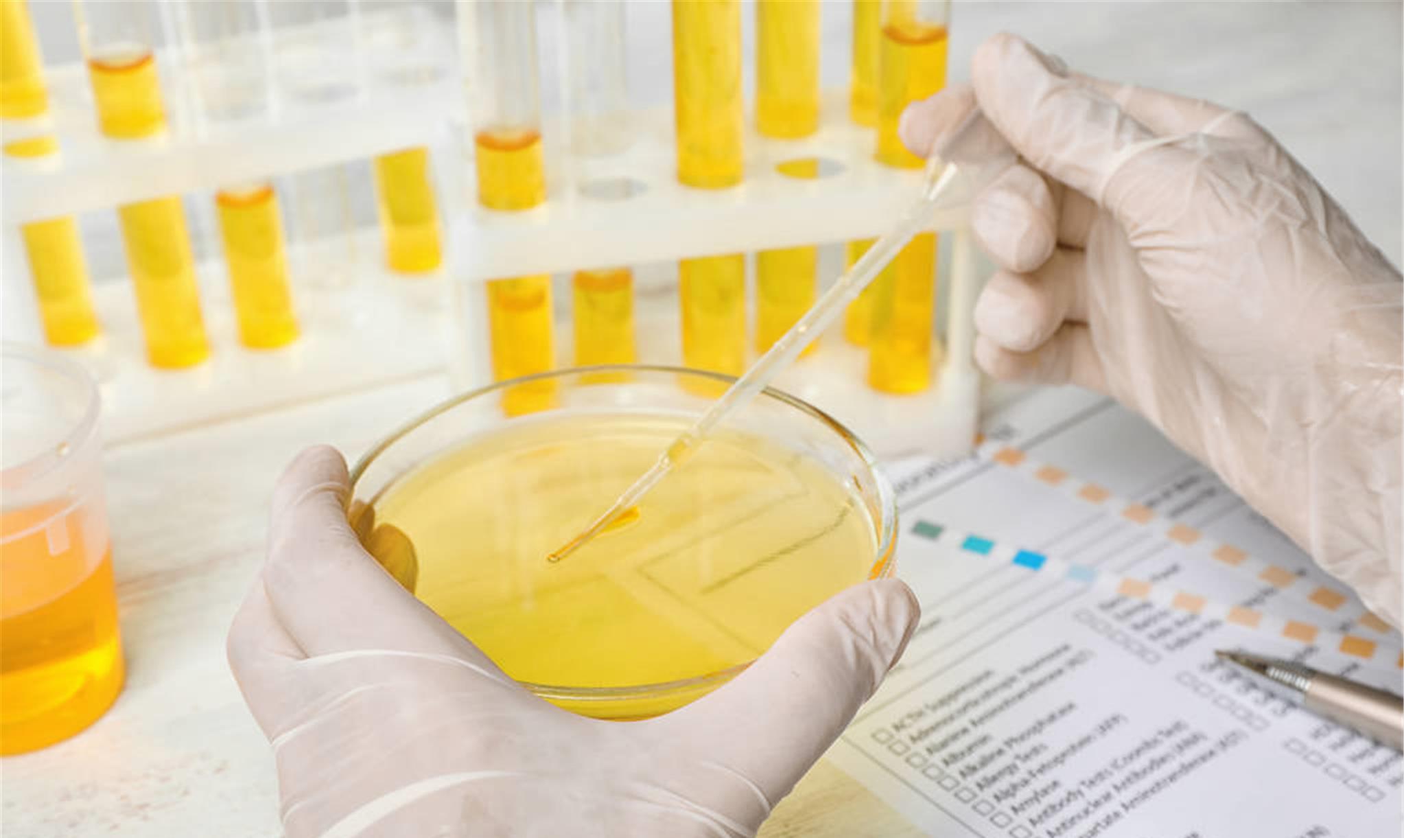 尿液检查:揭示健康秘密,发现潜在疾病的重要指标(图2) 科泌尿科_泌尿科_科泌尿外科